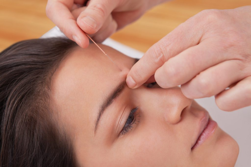 Contra dolor de cabeza: acupuntura