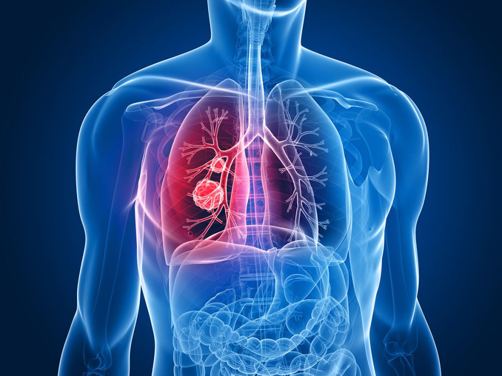 Llega una terapia innovadora para cáncer de pulmón
