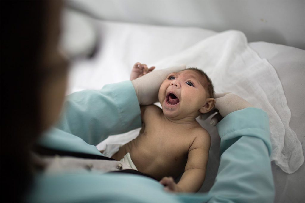 Nace en EEUU bebé con microcefalia
