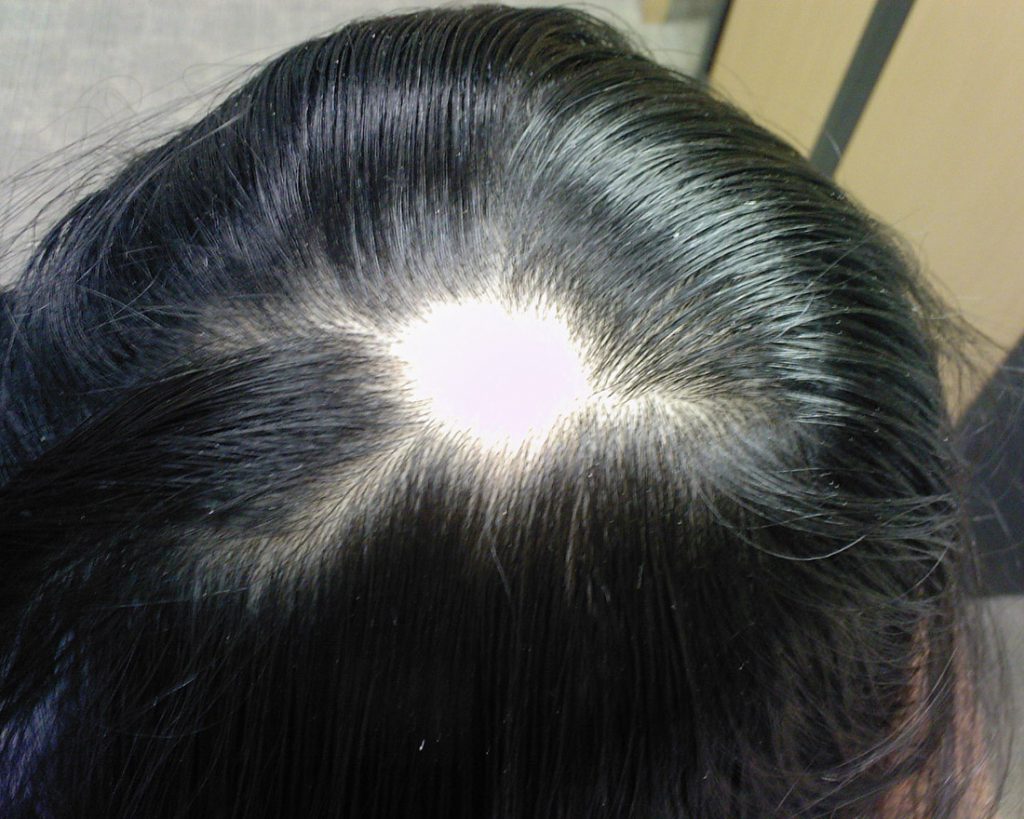 El gran enigma ¿porqué se cae el pelo?