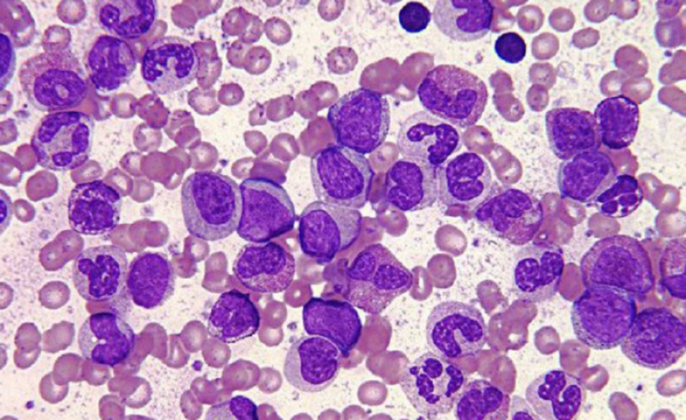 Leucemia linfocítica afecta a hombres adultos