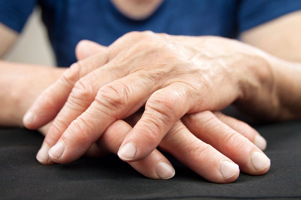 Deformidad en manos y pies por artritis reumatoide
