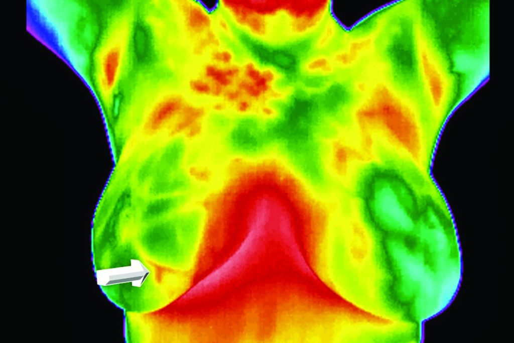 Termografía digital infrarroja técnica para detección de cáncer