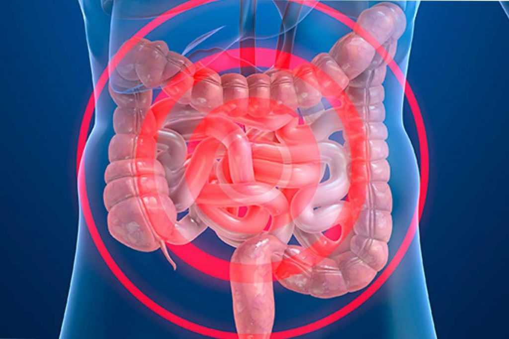 Los peligros de la silenciosa enfermedad intestinal