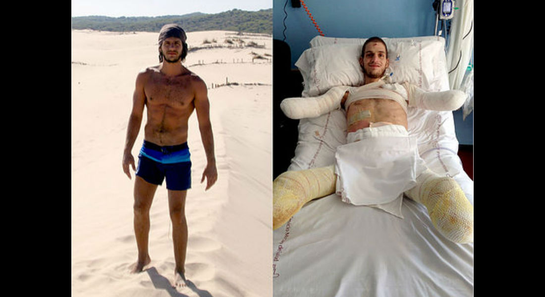 Joven pierde sus brazos y piernas tras diagnóstico erróneo