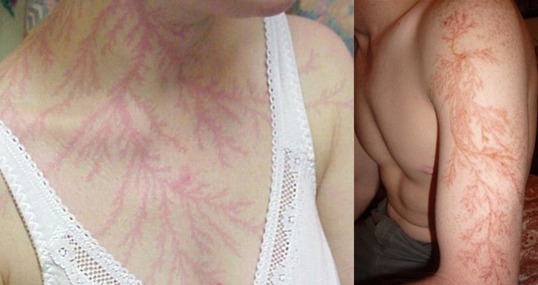 Las personas que han sobrevivido a la caída de un rayo tienen un hermoso tatuaje natural