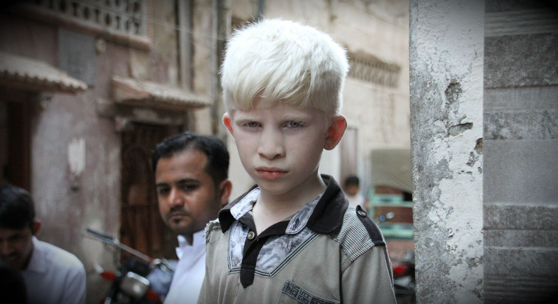 Hombre «da cuello» a joven albino para «hacerse millonario»