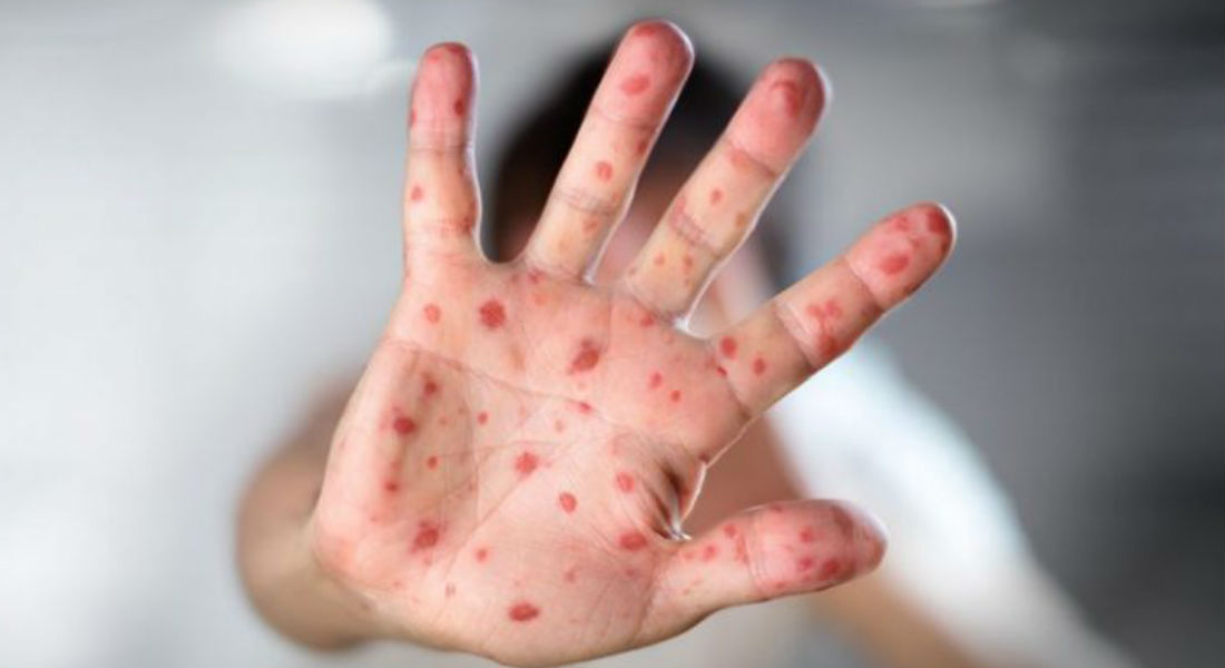 Reportan más de mil casos de sarampión en lo que va del año