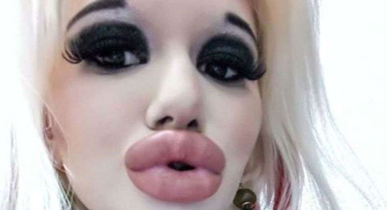 Con más de 15 cirugías, ella busca tener los labios más grandes del mundo