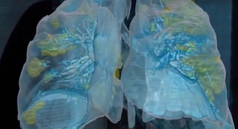 VIDEO: Así progresa el Covid-19 en los pulmones humanos